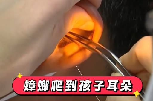 蟑螂爬到孩子耳朵，媽媽60秒無創急救很高明，醫生：堪稱教科書
